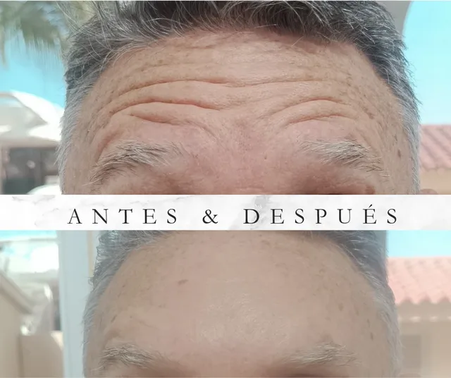 Resultados de Botox