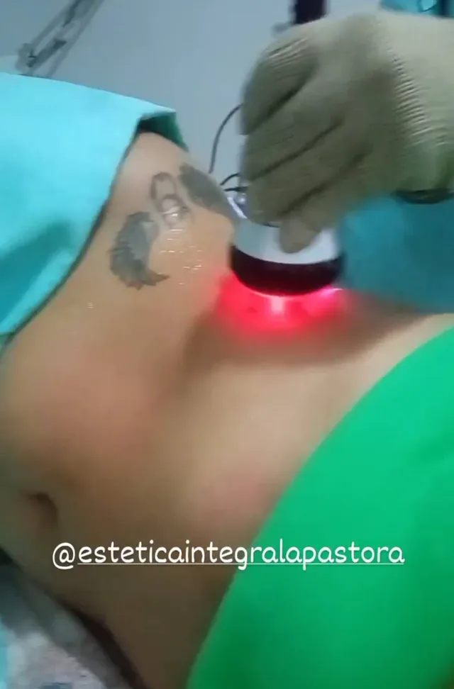 Tratamiento Reductor. Radiofrecuencia