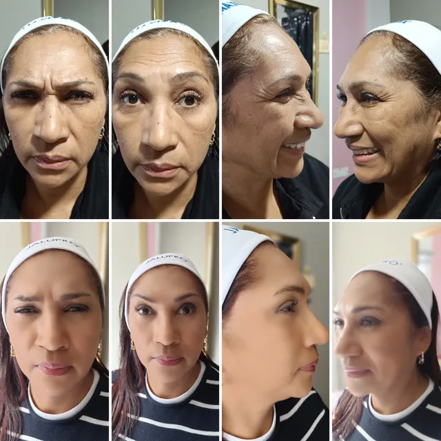 Resultados botox