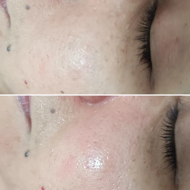 Resultados en limpieza facial