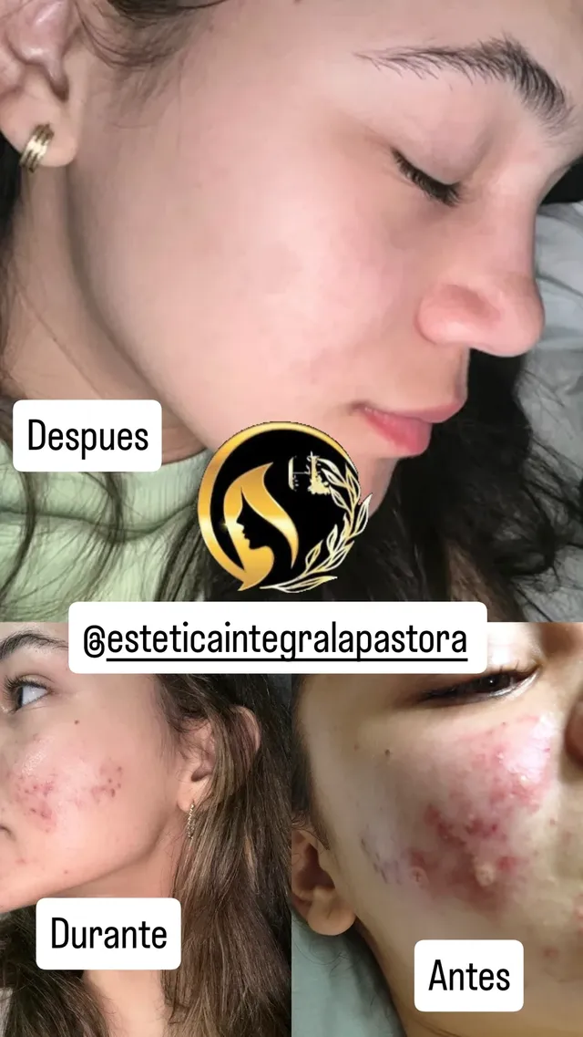 El antes , durante y después de un tratamiento de Cura de Acne